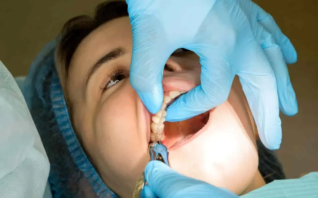 Remèdes de grand-mère après extraction dentaire : soulager naturellement la douleur