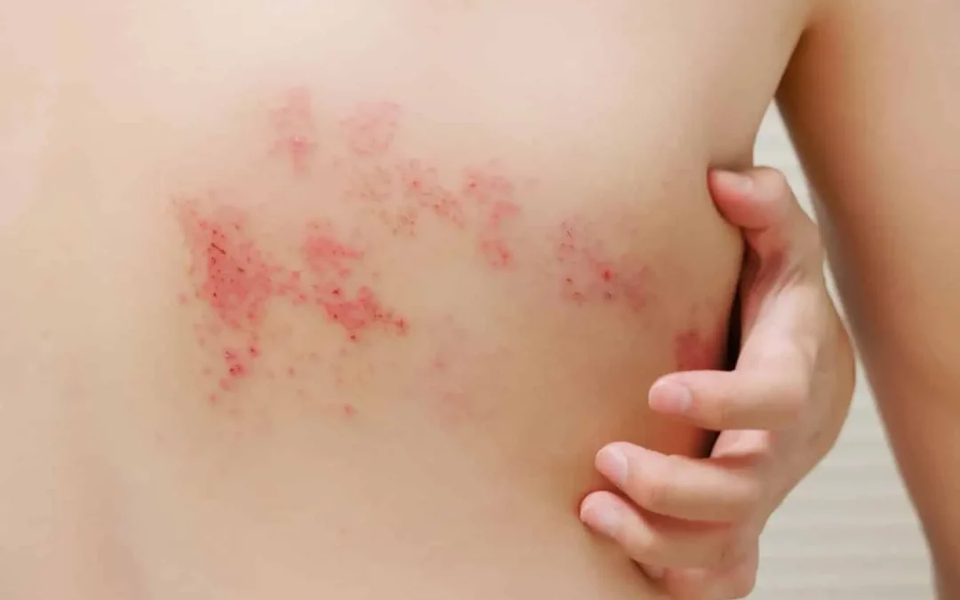 Le zona peut-il cacher un cancer ? Lien, risques et signaux d&rsquo;alerte