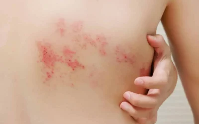 Le zona peut-il cacher un cancer ? Lien, risques et signaux d’alerte