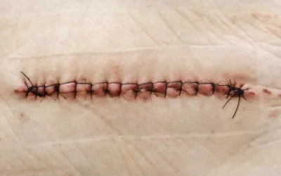 Un fil de suture oublié sous la peau : que faire et quand s&rsquo;inquiéter ?