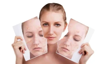 Petit bouton blanc sur le corps : guide complet pour identifier et traiter ces imperfections