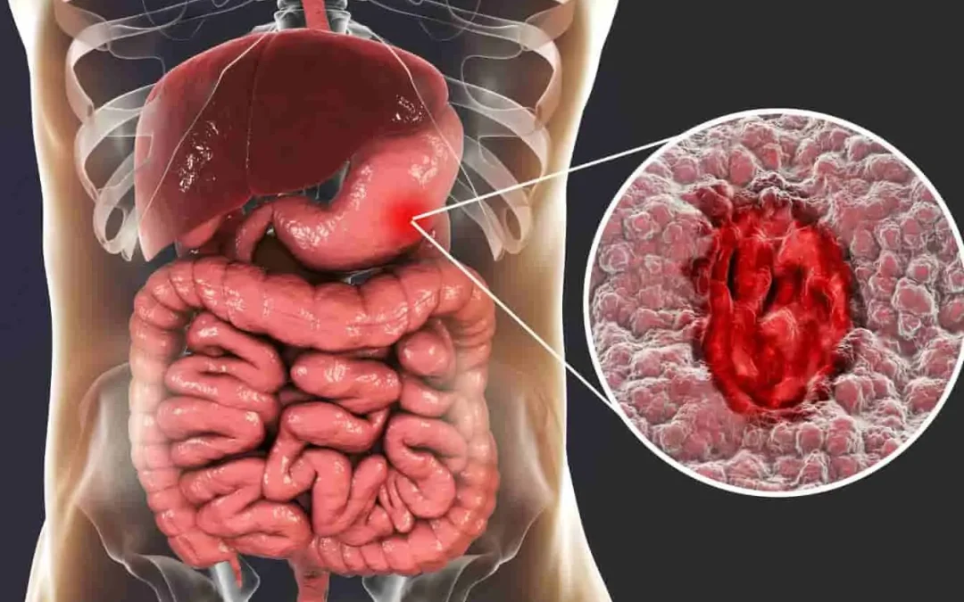 Peut-on mourir d&rsquo;un ulcère à l&rsquo;estomac ? Comprendre les risques et les complications
