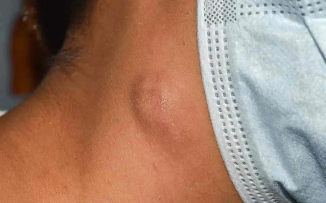 Ganglion dans le cou : définition, causes fréquentes et signaux d&rsquo;alerte