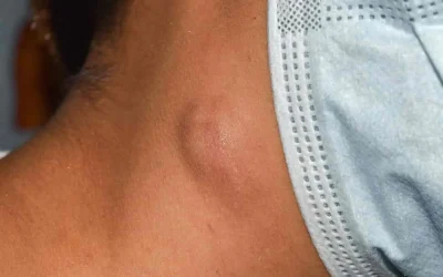 Ganglion dans le cou : définition, causes fréquentes et signaux d&rsquo;alerte