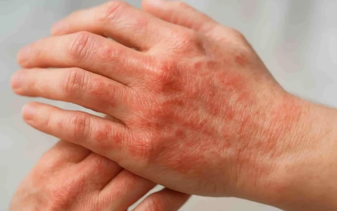 Traitement de l&rsquo;eczéma bulleux : solutions médicales, gestion des cloques et soins quotidiens