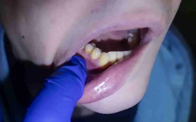 Détartrer les dents : guide complet pour un sourire sain