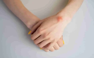 Lipome graisseux : comprendre, identifier et traiter cette tumeur bénigne de la peau