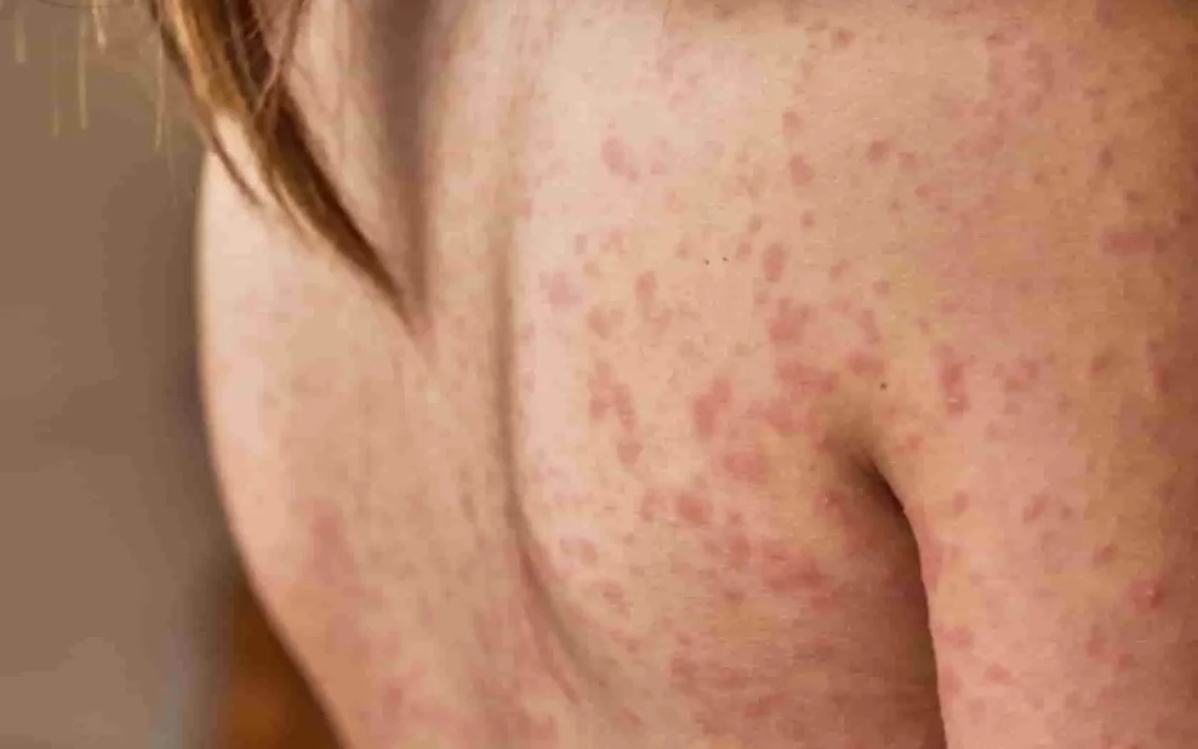 Minuscules points rouges sur la peau : identification, causes et solutions