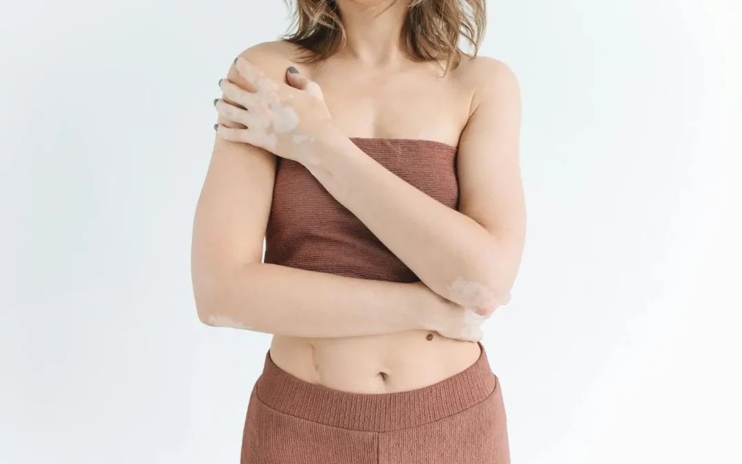 Psoriasis : les remèdes naturels et solutions douces pour soulager les plaques