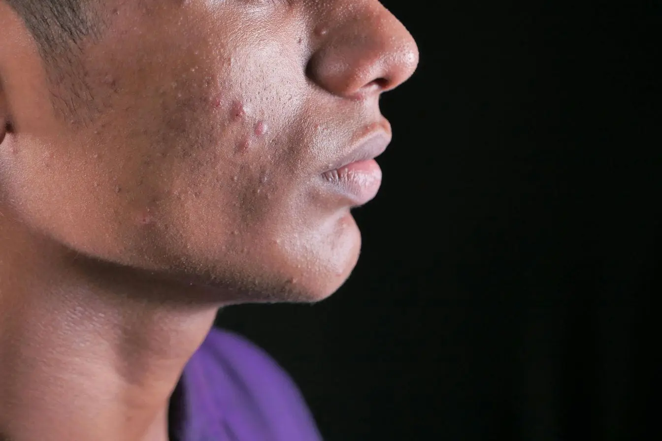 Gros plan sur joue avec boutons rouges, image illustrant la nécessité de soins dermatologiques pour traiter un kyste sébacé.