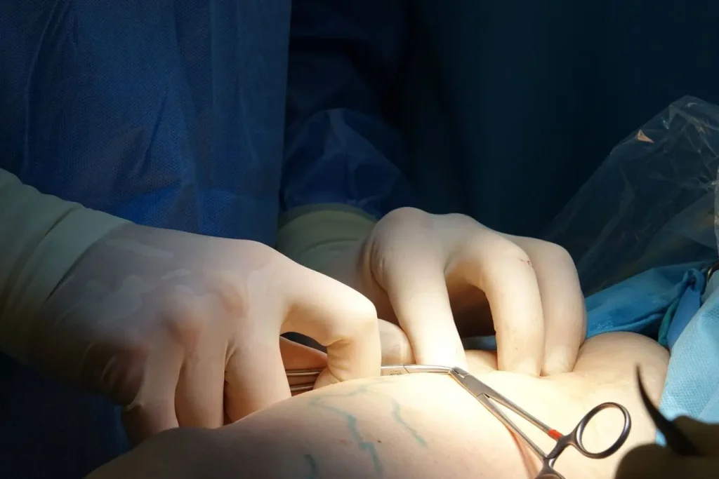 Chirurgie sur jambe avec marquages bleus, image qui traduit la nécessité de soins préventifs pour limiter les varices
