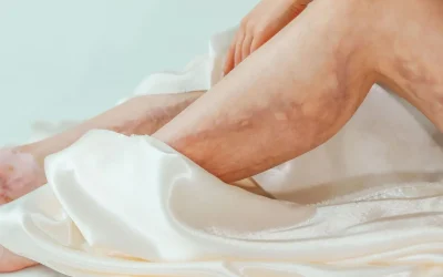 Comment prévenir les varices naturellement ? Conseils et habitudes de vie