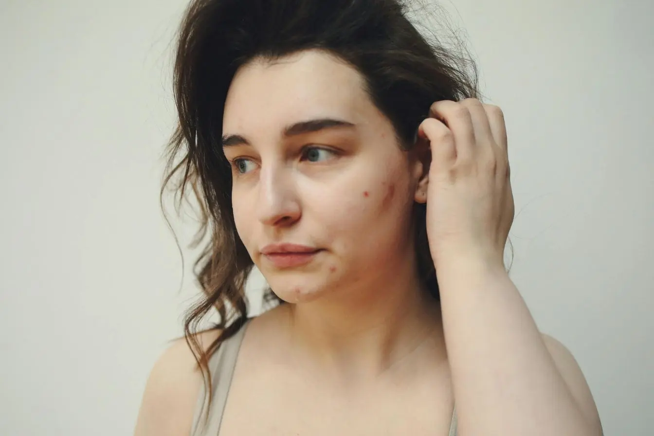 Visage naturel avec imperfections Personne au teint marqué par imperfections, image qui illustre l’importance d’une alimentation anti-acné pour améliorer la santé de la peau.