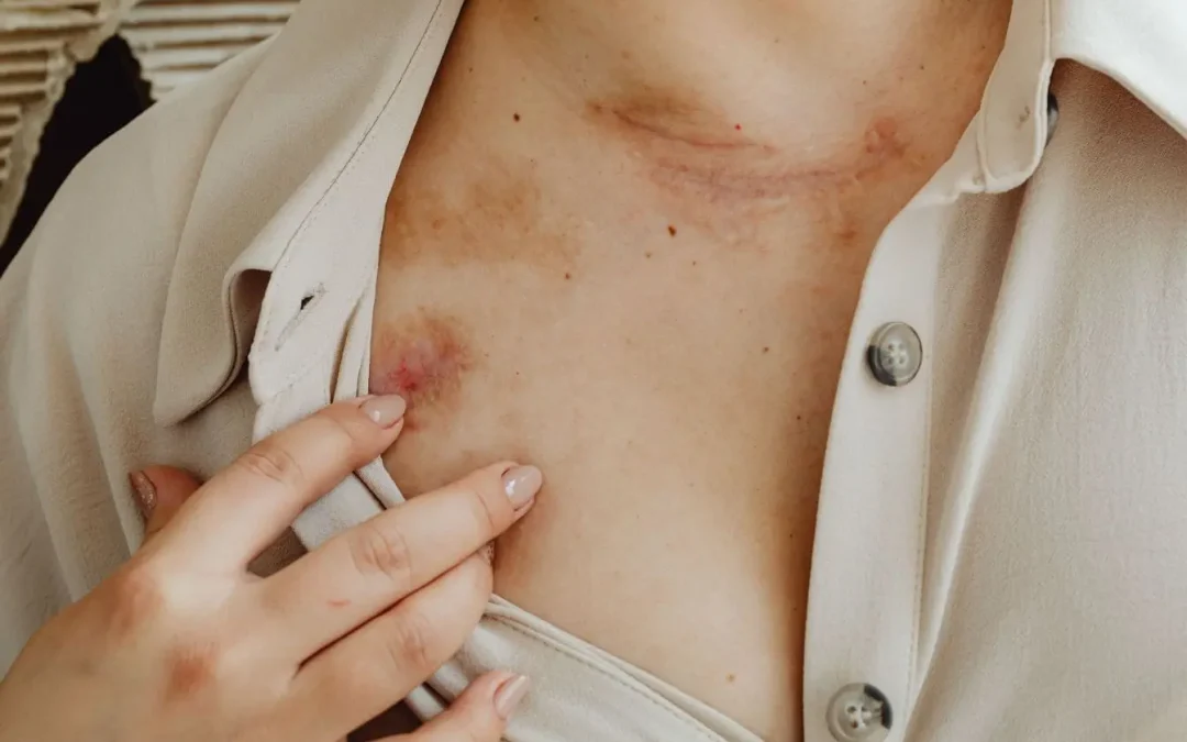 Comment soigner un hématome rapidement ? Les bons réflexes et traitements
