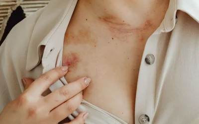 Comment soigner un hématome rapidement ? Les bons réflexes et traitements