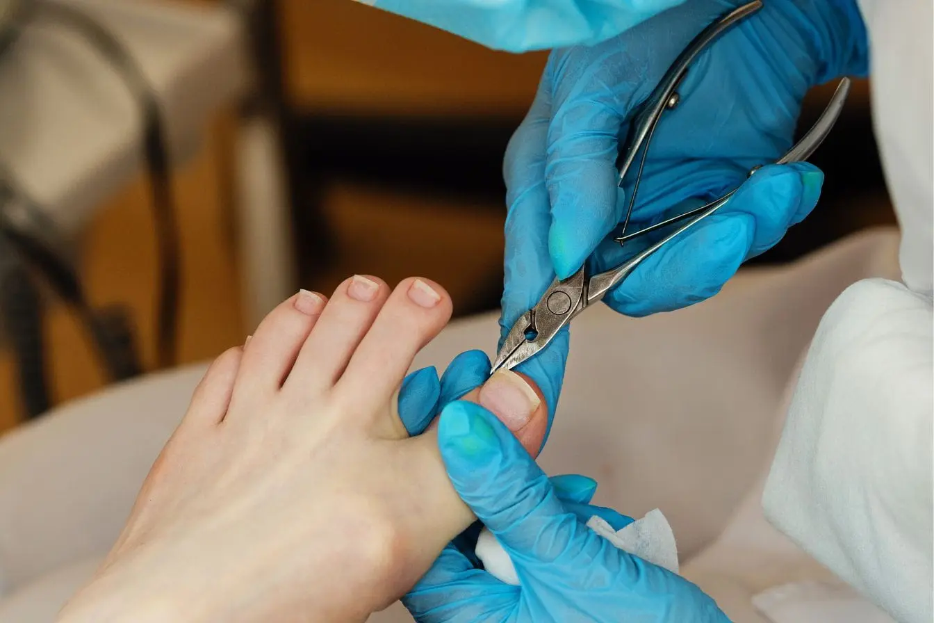 soin d’un ongle incarné Gros plan sur des mains gantées en bleu utilisant un outil métallique pour traiter un orteil, image qui illustre le soin d’un ongle incarné.